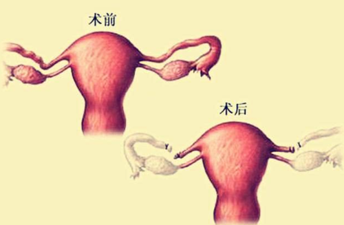 女人结扎了还能生吗 女人结扎有什么好处(图1) 女人结扎了还能生吗 女人结扎有什么好处(图1)