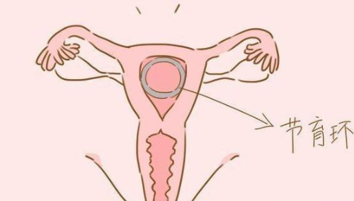 女人结扎了还能生吗 女人结扎有什么好处(图3) 女人结扎了还能生吗 女人结扎有什么好处(图3)