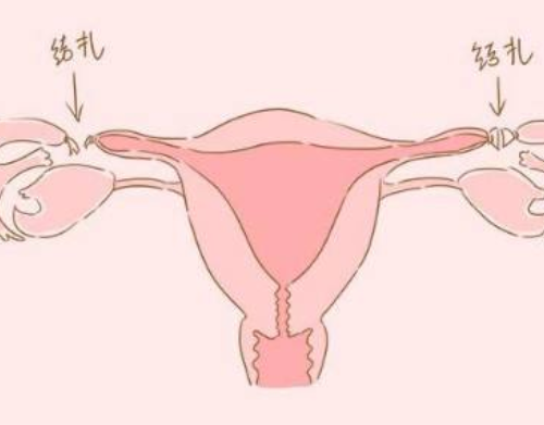 结扎和不结扎的女人有何区别 结扎对女性最大的危害是哪些(图3) 结扎和不结扎的女人有何区别 结扎对女性最大的危害是哪些(图3)